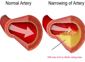 Cao mỡ máu - Tổng quan chi tiết